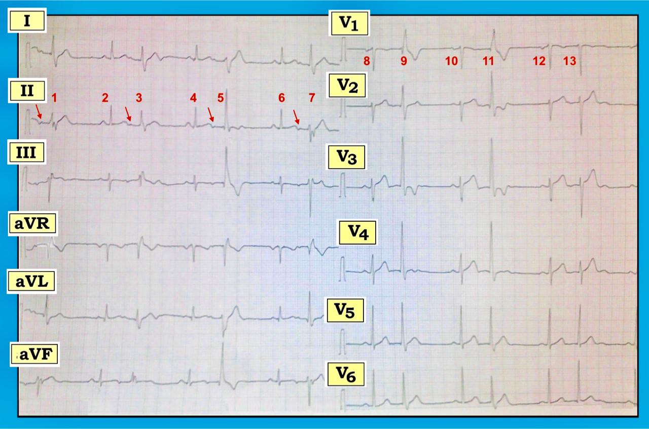 ECG Review