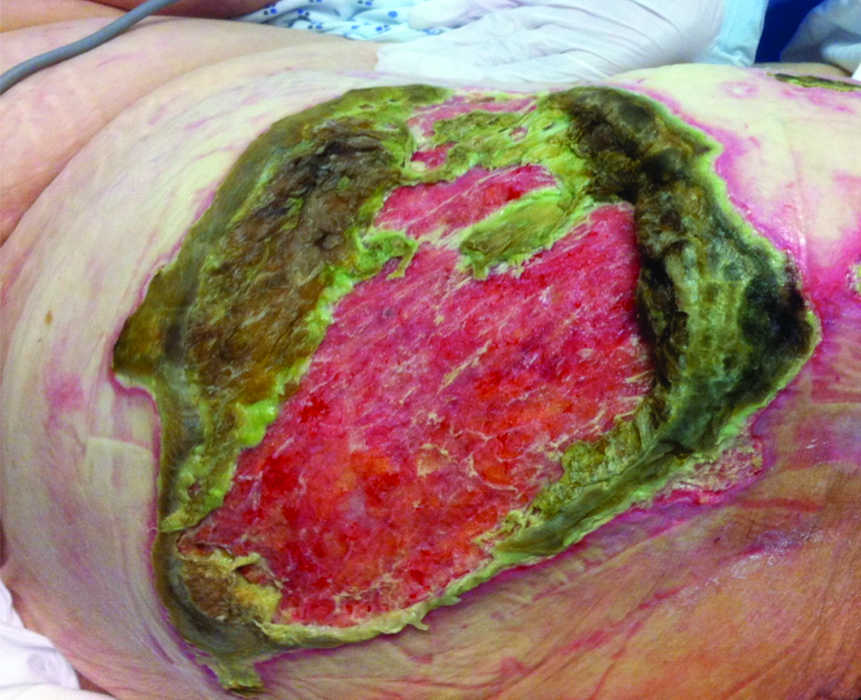 Atypical later Wound