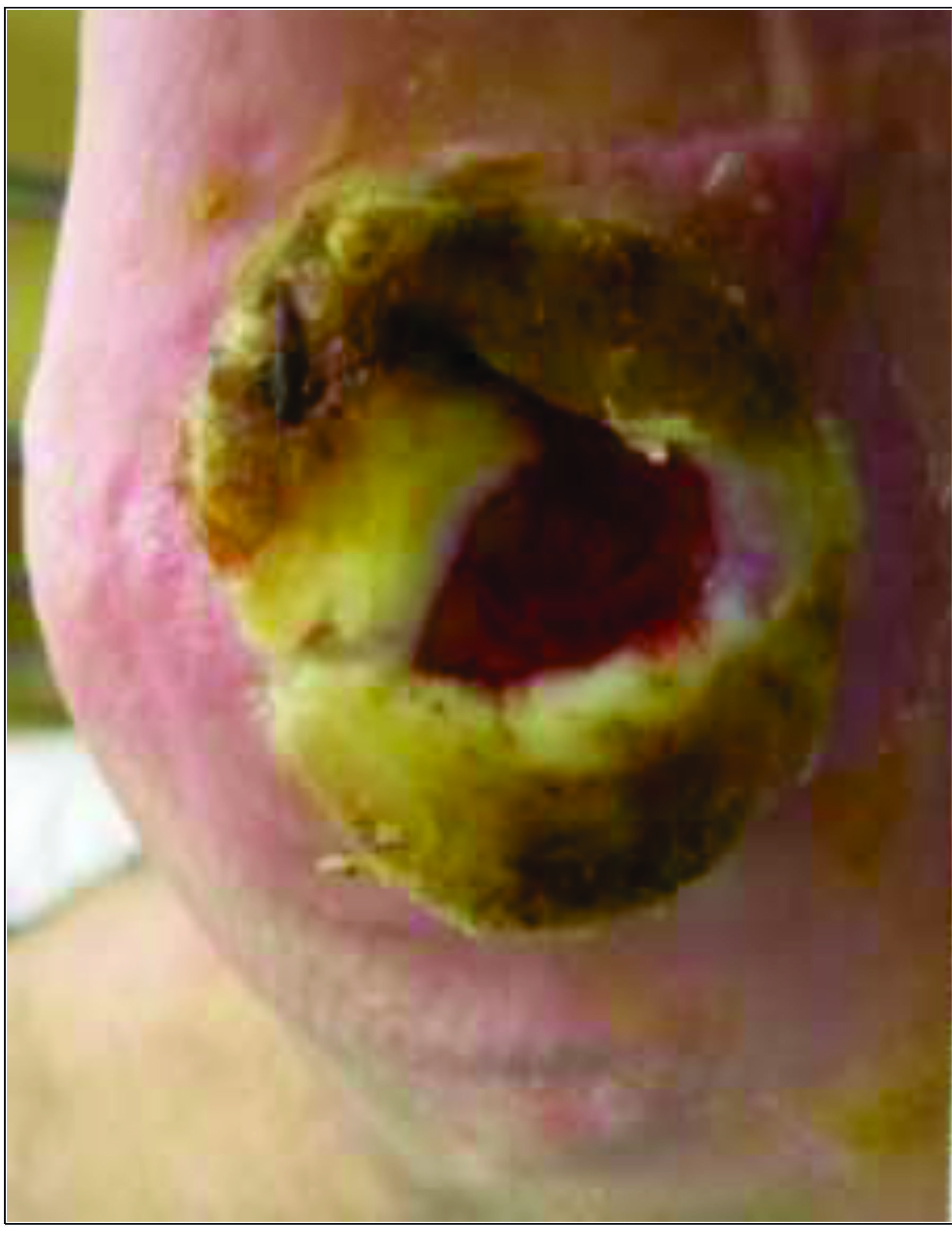 Diabetic Wound