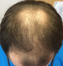 Evaluation of Hair Loss in a Primary Care Setting - 2018-10-19 - Relias Media - Continuing ...
