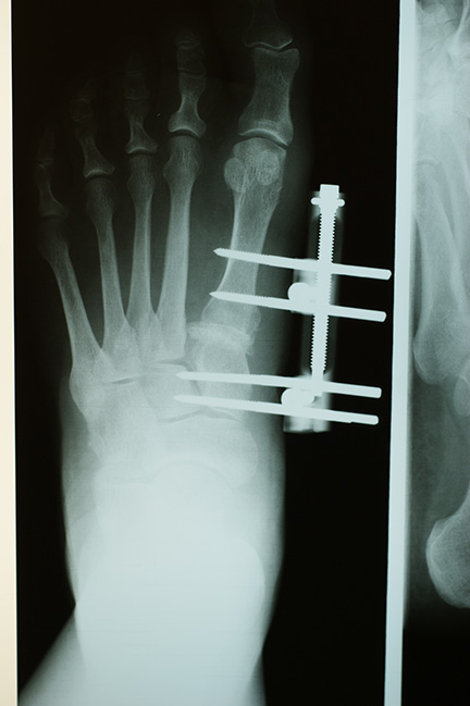 Bunion X-ray