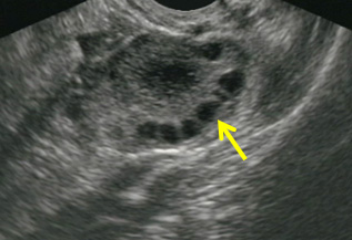 Ovarian Ultrasound
