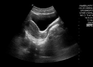 Ovarian Ultrasound