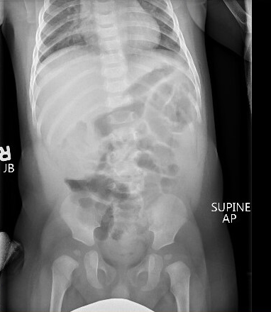 Radiograph Intussusception