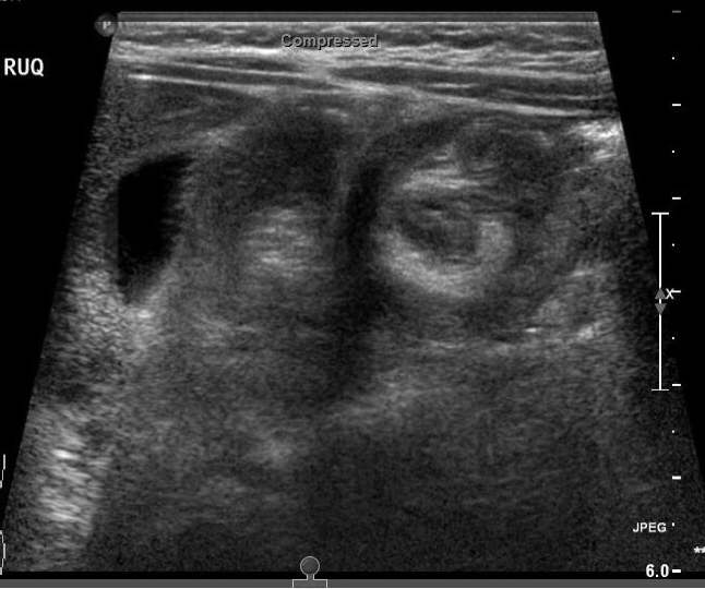 US Intussusception