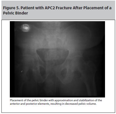 Figure 5. Patient with APC2 Fracture After Placement of a Pelvic Binder