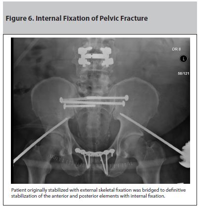 Figure 6. Internal Fixation of Pelvic Fracture