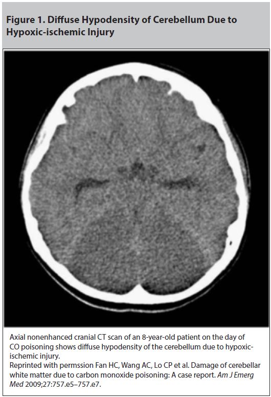 Figure 1. Diffuse Hypodensity of Cerebellum Due to Hypoxic-ischemic Injury