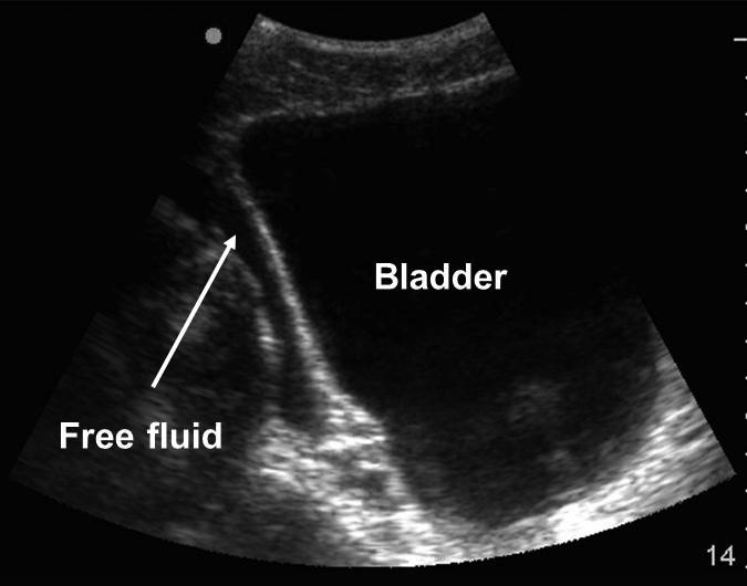 Free fluid around bladder