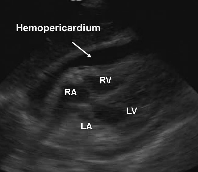 Hemopericardium