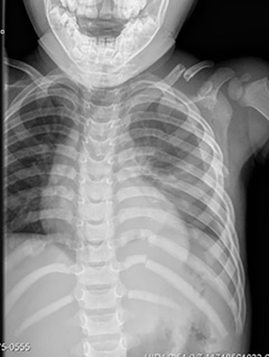 pediatric ribs and clavicle fracture