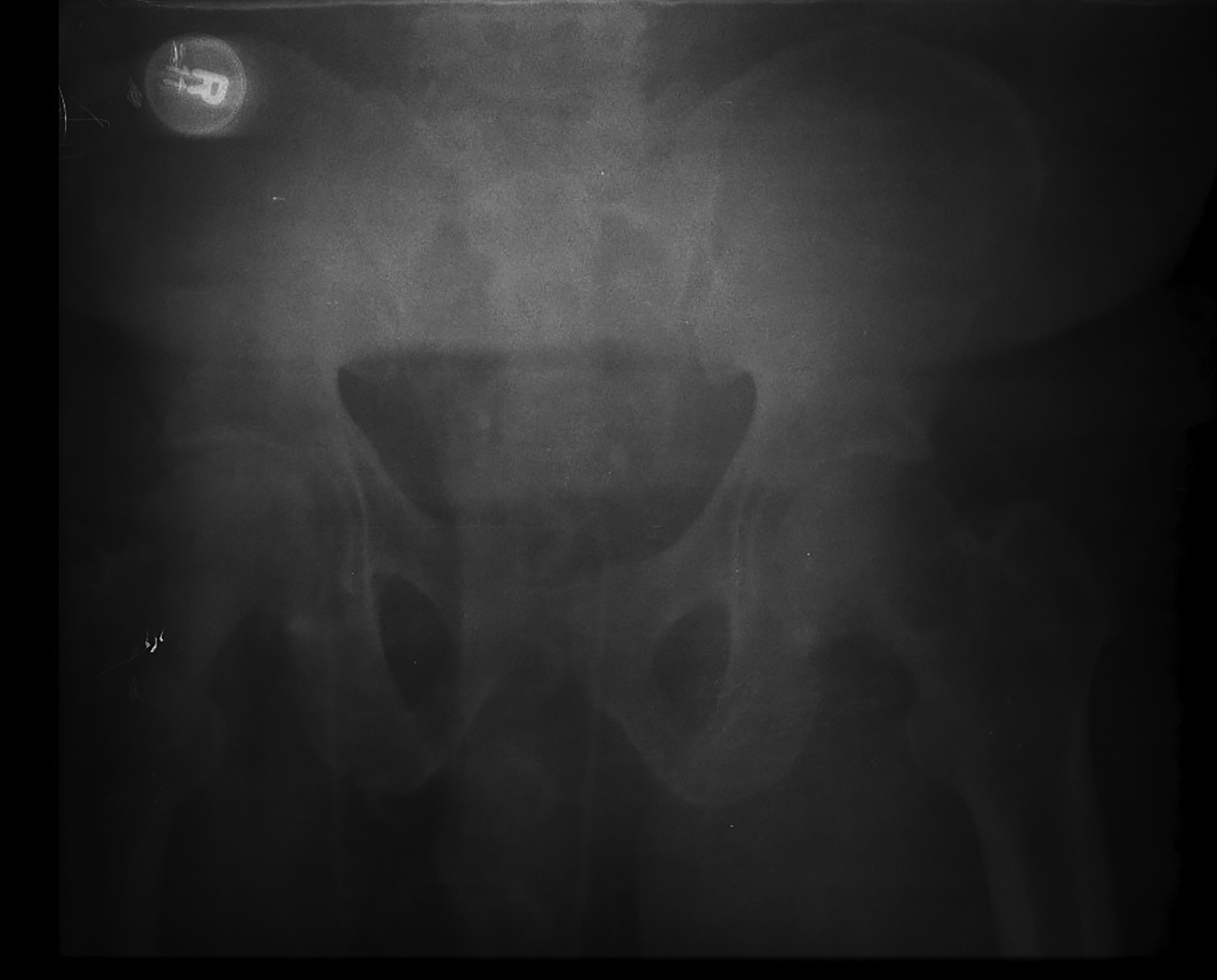 Pelvic fracture after placement of pelvic binder