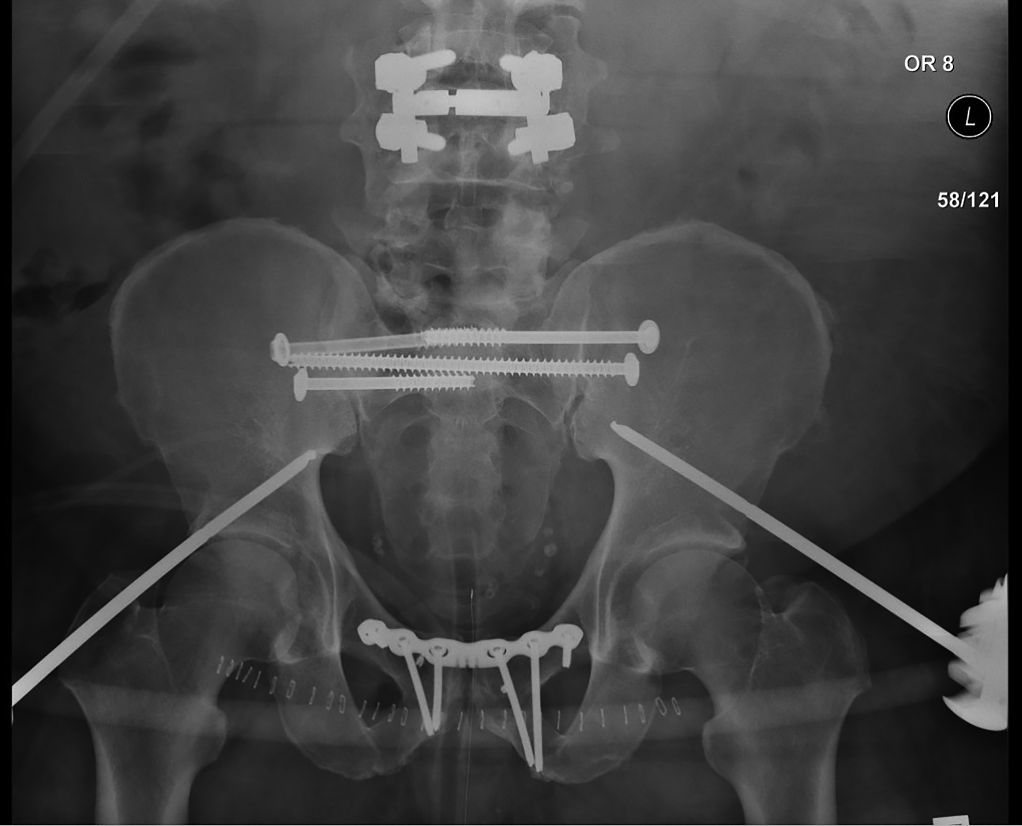 Internal fixation of pelvic fracture