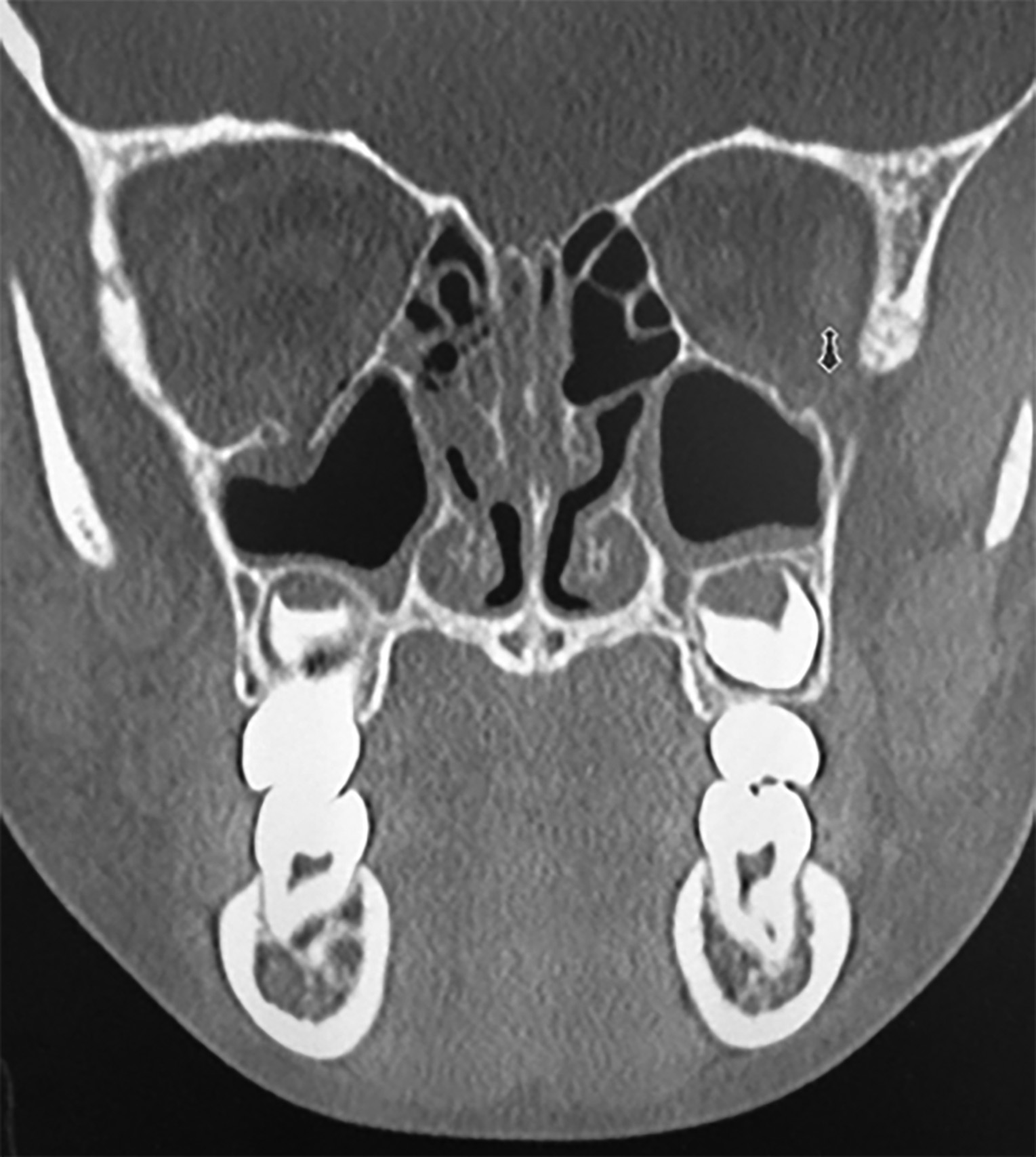 Orbital floor fracture