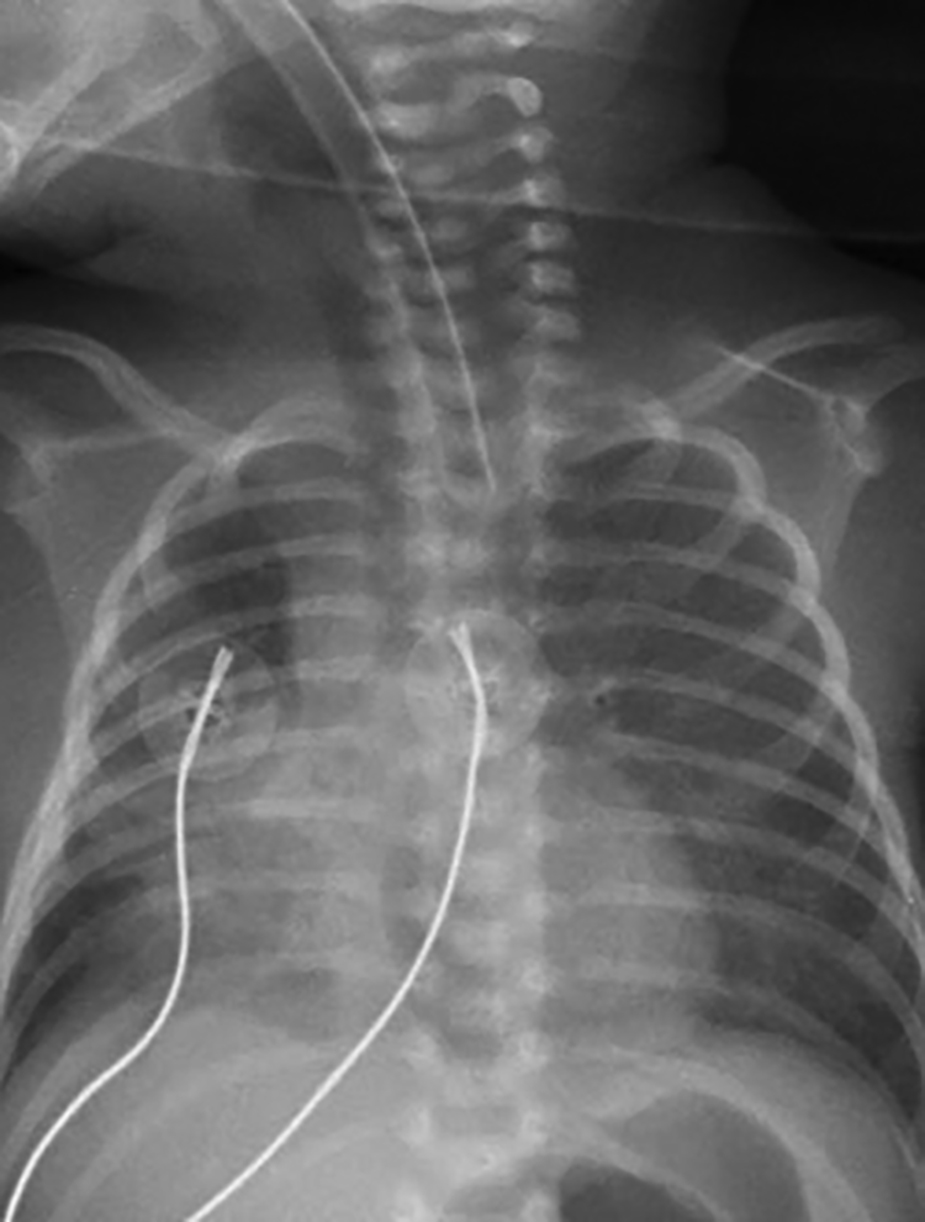 Chest radiograph following drowning event