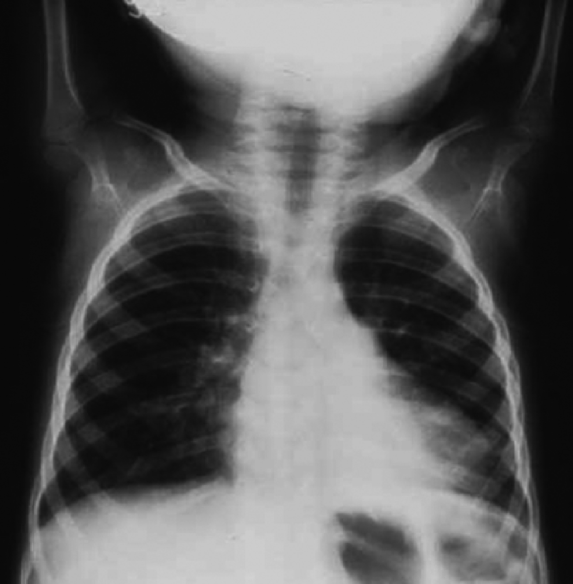 Chest radiograph with atelectasis