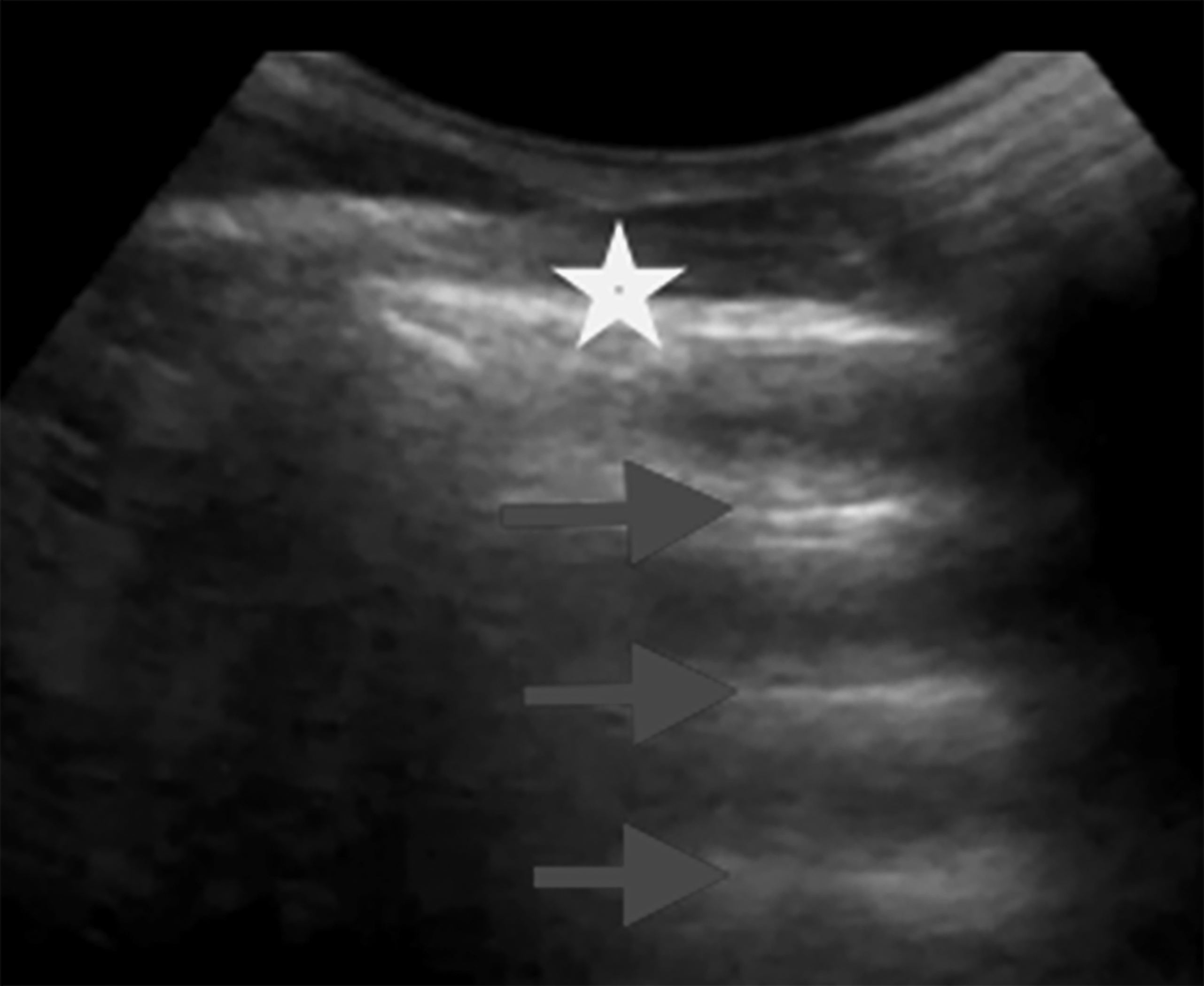 Lung ultrasound demonstrating A lines