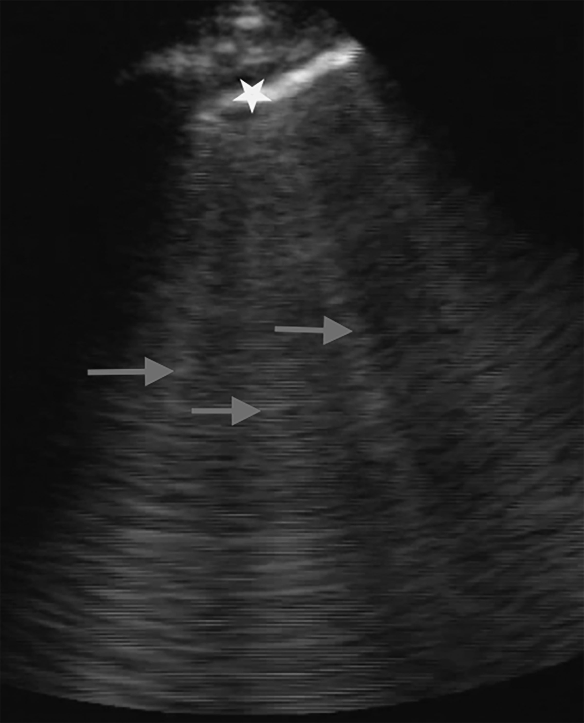 Point-of-care ultrasound of lung